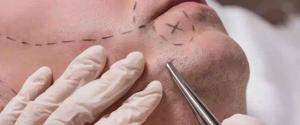 landing-baard